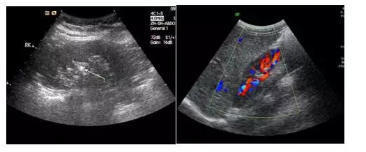 黑白超和彩超有什么區(qū)別