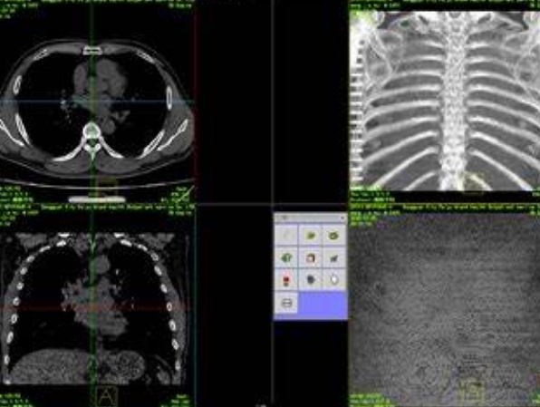三維重建技術(shù)的革新：智能影像，精準(zhǔn)醫(yī)療的新篇章
