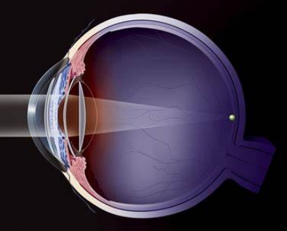 眼科醫(yī)療的未來：揭秘多焦點人工晶狀體的創(chuàng)新設(shè)計