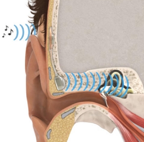重塑聽(tīng)力，聆聽(tīng)夢(mèng)想：揭秘最新人工中耳植入技術(shù)的創(chuàng)新
