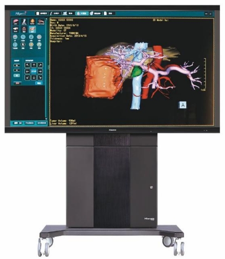 骨科手術(shù)的精確導(dǎo)航：計算機(jī)輔助手術(shù)（CAS）系統(tǒng)的作用