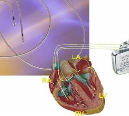 心臟起搏器技術(shù)進(jìn)步：更長壽、更健康的未來