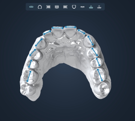 正畸分析軟件：數(shù)字化正畸規(guī)劃——正畸分析軟件的精準(zhǔn)設(shè)計(jì)與應(yīng)用