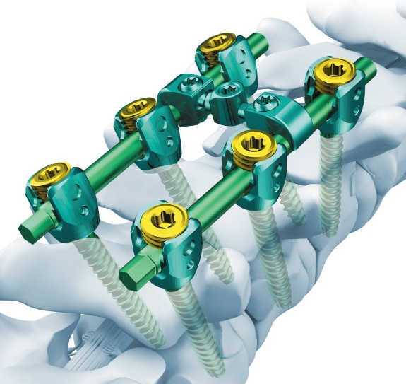 脊柱固定系統(tǒng)：穩(wěn)定脊柱，緩解疼痛——脊柱固定系統(tǒng)的設(shè)計與實施要點