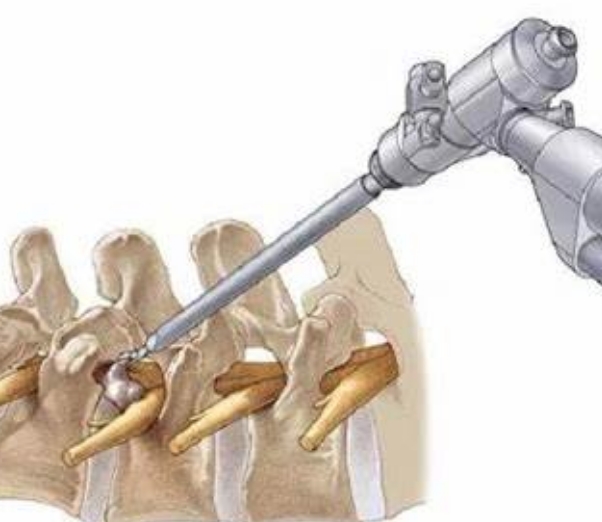 椎間盤鏡：微創(chuàng)治療椎間盤疾病——椎間盤鏡的技術(shù)進(jìn)展與操作指南